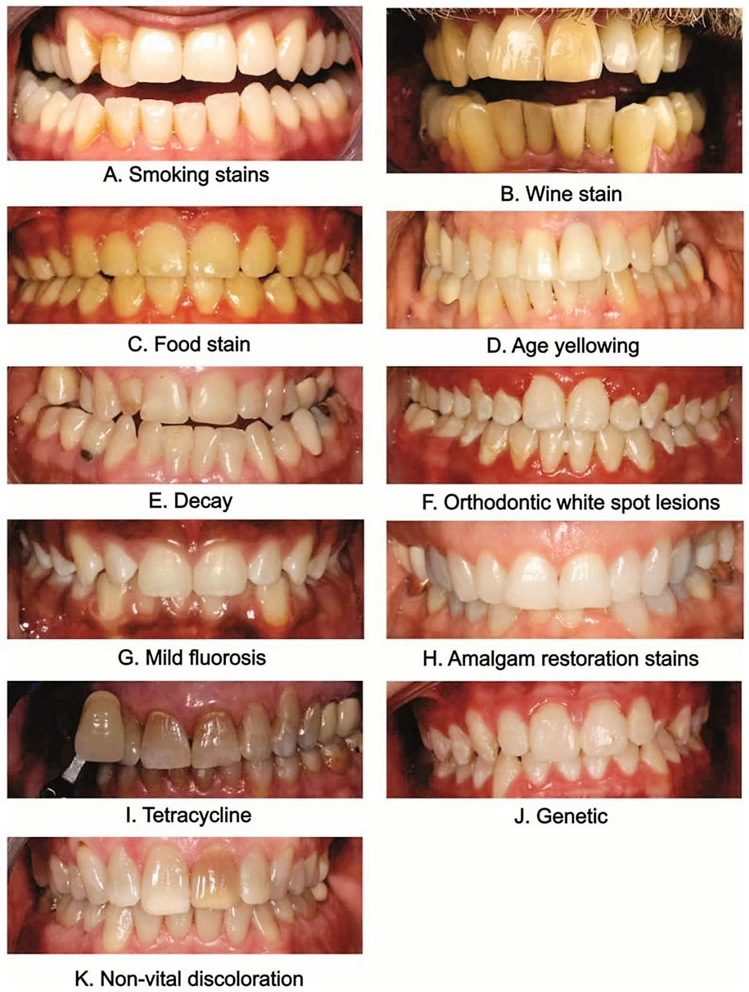 Dental Scaling, Teeth Cleaning, Stains on teeth Dental Scaling, Teeth Cleaning, Stains on teeth